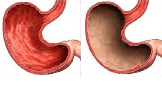 Ulcers, gastritis, cancer, and other stomach problems (right), the appearance of which is caused by alcohol